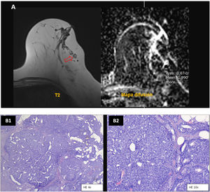 Caso 1. Adenomioepitelioma maligno. A): La resonancia magnética muestra un nódulo hiperintenso (flecha) (T2 izquierda) sin restricción de difusión (mapa de ADC derecha). B) El examen de anatomía patológica postumorectomía mostró múltiples nódulos que muestran diferente proporción de células glandulares y mioepiteliales proliferantes en patrones seudopapilares y cribiformes, destacando células mioepiteliales de aspecto epitelioide atípico, con núcleos agrandados e irregulares, algunos con nucléolo, rodeados de moderado citoplasma eosinófilo pálido o claro, y abundantes figuras de mitosis (algunas presentes en la imagen B2) y sin necrosis tumoral (tinción hematoxilina-eosina; B1 a 4 aumentos y B2 a 10 aumentos).