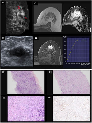 Caso 2. Adenomioepitelioma benigno. A) La mamografía muestra un nódulo irregular en la unión de los cuadrantes superiores de la mama izquierda (flechas). B): La ecografía en escala de grises revela una masa sólida heterogénea y mal definida de 15 mm. C1) La resonancia magnética muestra una lesión tipo masa hiperintensa en secuencias T2 (izquierda) sin restricción de difusión (derecha). C2) El estudio de contraste dinámico mostró realce en anillo y una curva con cinética de tipo II. Las imágenes histológicas revelaron una proliferación bifásica de abundantes células mioepiteliales que rodeaban glándulas ocasionales con secreciones luminales focales. D1 y D2) Bajo aumento de la biopsia con células mioepiteliales predominantes. D3) Imagen de mayor aumento con proliferación de células mioepiteliales fusiformes. D4) La tinción inmunohistoquímica de actina resalta el componente mioepitelial.