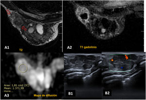 Caso 3. Adenomioepitelioma maligno: La RM muestra un nódulo bien delimitado, ovalado y heterogéneo en T2 (A1) que capta gadolinio formando anillos (A2) y que no restringe en la difusión (A3). El estudio ecográfico (B1) pone de manifiesto un nódulo sólido de bordes angulados y lobulaciones con Doppler positivo (B2).