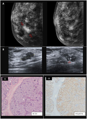 Caso 6. Adenomioepitelioma benigno. A) La mamografía muestra un nódulo parcialmente circunscrito con calcificaciones en la unión de los cuadrantes internos de la mama derecha (flechas). B) La imagen de ultrasonido en escala de grises revela una lesión nodular sólida lobulada de 14 mm con márgenes angulares y calcificaciones (punta de flecha). El examen de anatomía patológica posterior a la tumorectomía muestra nódulos agregados circunscritos de población celular dual de células mioepiteliales claras que rodean células epiteliales glandulares (C1). Las células mioepiteliales se demuestran en el tumor mediante la inmunotinción p63 (C2).