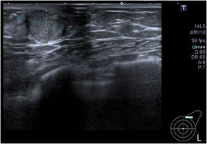 Ecografía de la mama izquierda con un nódulo sólido 2 x 1,5 cm, BIRADS 5.