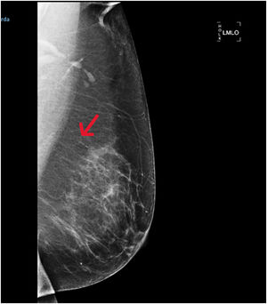 Mamografía oblicua mediolateral de la mama izquierda donde se objetivan microcalcificaciones lineales en el cuadrante superoexterno.