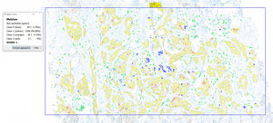 Example of the results visualization by pathologists in a selected area with the corresponding quantification. Example of the results visualization by pathologists in a selected area with the corresponding quantification.