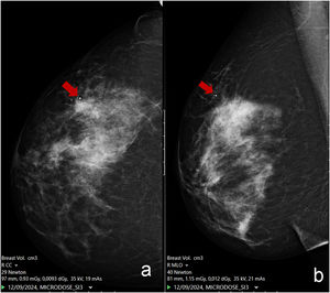 Mammographic image of the lesion before biopsy with the metallic part of the HydroMark© visible (arrow) (a). The lesion was almost totally removed, and the metallic marker is seen (arrow) (b).