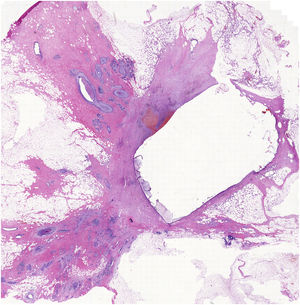 Microscopic image of the surgical biopsy with the space of HydroMark© surrounded by fibrous tissue with residual infiltrating and intraductal carcinoma. The original device measures 3 mm in diameter by 16 mm in length. The space occupied by the HydroMark in the resection specimen measures approximately 7 × 10 mm. Its increase is due to the tissue water absorption by the device.