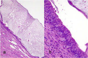 Histiocyte reaction forming a pseudocapsule around a basophilic material corresponding to the hydrogel (a). The appearance of this reaction is similar to synovial metaplasia (b).