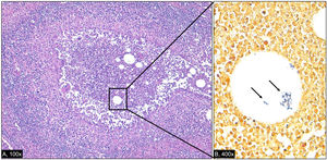 Epithelioid granuloma with central suppurative (neutrophilic) inflammation surrounding lipid vacuoles (A). Within the lipid vacuoles, Gram-positive bacilli (arrows) are identified, consistent with Corynebacteria (B).