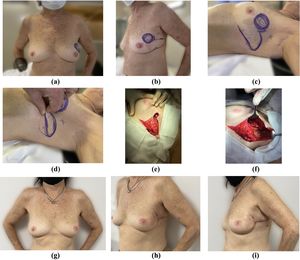 Resección de carcinoma multifocal del cuadrante supero externo de la mama izquierda más vaciamiento axilar en mama de pequeño tamaño. Reconstrucción con colgajo LICAP/LTAP.