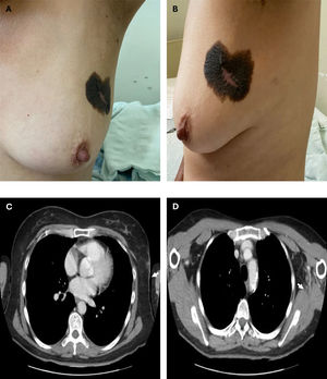 Physical examination findings. (A, B) Hyperpigmented, irregular lesion on the tail of the left breast, measuring 4 cm. (C) Coronal chest tomography with contrast; arrow indicates skin thickening in the tail of the left breast and an ovoid image measuring 4 x 5 mm. (D) Left axillary lymph nodes measuring 17 x 10 mm (arrow).