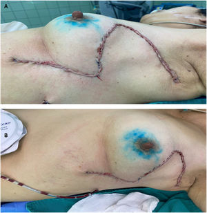 Surgery. (A, B) Left breast quadrantectomy and sentinel node biopsy were performed, followed by reconstruction using Holmström