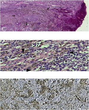 Microscopy. Haematoxylin & Eosin staining. (A) 10X magnification: Cutaneous melanoma with infiltrating neoplastic cells containing melanin pigment (arrow). (B) 40X magnification: Melanoma cells forming infiltrating neoplastic nests with melanin pigment (arrowhead). (C) Immunohistochemistry: Melan-A positive.
