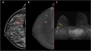 Asymptomatic 45-year-old patient seen at our institution for routine mammography. A. The low-energy image showed a suspicious mass classified as BI-RADS 4. B. The recombined CEM image revealed an additional suspicious mass. C. Contrast-enhanced MRI (T1 post-contrast sequence) showed two suspicious nodular enhancements, with good correlation with the recombined CEM image. Pathological study diagnosed two luminal B invasive ductal carcinomas, true positive for both imaging techniques.