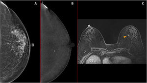 Asymptomatic 64-year-old patient. A and B. Low-energy and recombined images showing a metallic clip. No suspicious enhancement was detected (false negative for CEM). C. Preoperative MRI (T1 post-contrast sequence) showed a nodular enhancement corresponding to a true positive on MRI. Pathological evaluation confirmed the lesion as luminal A invasive ductal carcinoma.