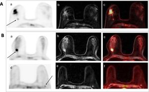 Case A. Selective breast 18F-FDG PET/MRI: axial PET (a), axial T2-weighted MRI (b) and axial fused PET/MRI (c) focused on the right breast showing multifocal lesions. Solid and spiculated hypermetabolic mass (44 × 35 mm) in the lower outer quadrant of the right breast with a SUVmax of 8.8. It is associated with a 17 mm hypermetabolic nodule (SUVmax 2.9) at the junction of the lower quadrants, approximately 27 mm deep from the tumor mass. Case B. Selective breast 18F-FDG PET/MRI: axial PET (a, d), axial T2-weighted MRI (b, e) and axial fused PET/MRI (c, f) (upper line focused on the right breast lesion (arrow), lower line focused on the left breast lesion (arrow). Hypermetabolic lesion at the junction of the outer quadrants of the right breast, posterior third, with spiculated margins of 19 mm (SUVmax 7.6). A solid hypermetabolic nodule measuring 9 mm (SUVmax 2.3) in the left breast at the depth of the junction of the upper quadrants, located prepectorally.