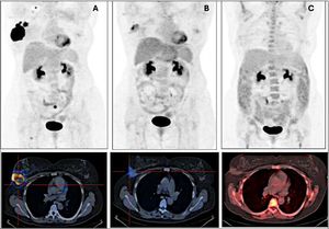 Basal of [18F]FDG-PET/CT of a 46-year-old woman diagnosed with CDI of the right breast pure HER2(+) phenotype with lymph node involvement. (A) also detects adenopathic involvement in the right supraclavicular region and bone involvement in the sacrum and right femur of [18F]FDG-PET/CT after two cycles (B) shows partial response in breast tumor and lymph nodes and complete metabolic response at the end of treatment (C). Mastectomy and lymphadenectomy revealed a complete histological response in both locations. [18F]FDG-PET/CT at the end of treatment correctly cataloged both responses.