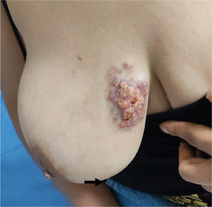 Multilobed lesion in the upper inner quadrant of the right breast, soft and mobile, measuring 4 × 5 cm, located in R1 to R4 (Arrow).
