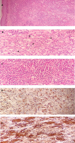 Microscopy. Haematoxylin & Eosin. To.: 10X. Under the epidermis, an increase in cellularity is observed, made up of cells with clear cytoplasm of histiocytic appearance, surrounded by an inflammatory infiltrate. B. 40X. Increase in histiocytes with a large nucleus, hypochromatic, round and oval; the cytoplasm is eosinophilic and contains inflammatory cells, which is known as Emperipolesis (Arrow). C. 40X. Prominent infiltration of lymphocytes, plastic cells, and fibrosis. Microscopy. Immunohistochemistry.: D. CD68 positive. E. S100 positive.