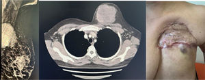 Clinical case. (A) Preoperative mammography. (B) Preoperative computed tomography. (C) Local recurrence following primary surgery.