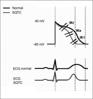 Representación del potencial de acción y su correlación con el electrocardiograma (ECG) en el síndrome de QT corto (SQTC). Ganancia de función en las corrientes de salida IKr, IKr e IK1, con acortamiento en la duración del potencial de acción en el SQTC.