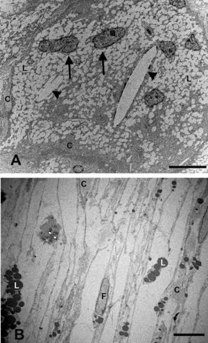 Microscopía electrónica de la supracoroides. A) conejos hipercolesterolémicos. Se observa una gran cantidad de células espumosas (flechas) en cuyo citoplasma se acumula una gran cantidad de lípidos. Entre las células se observan fibras de colágeno y cristales de colesterol (cabeza de flecha). B) En los animales tratados con estatinas, disminuyen las células espumosas y los lípidos se localizan principalmente dentro de los fibroblastos (F). (L: lípidos; C: colágeno) (B: animal tratado con Fluvastatina sódica). Barra: 10μm.
