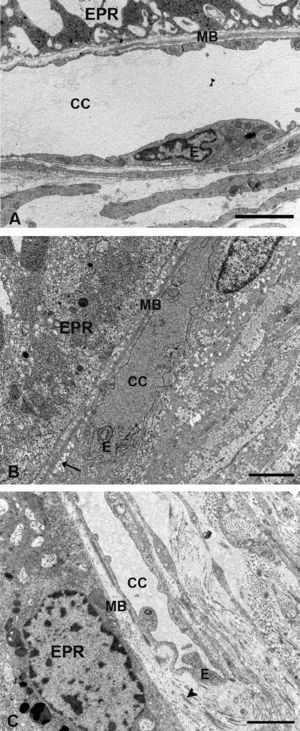 Microscopía electrónica de la coriocapilar y de la membrana de Bruch. A) Grupo control. B) En los animales hipercolesterolémicos se observa la necrosis de las células endoteliales de la coriocapilar y lípidos en la membrana de Bruch (flecha). C) Animales tratados con estatinas el endotelio de la coriocapilar no presenta signos de necrosis. No se observan lípidos en la membrana de Bruch pero las fibras de colágeno son más gruesas (cabeza de flecha). (CC: coriocapilar; E: célula endotelial; EPR: epitelio pigmentario de la retina; MB: membrana de Bruch). (C: animal tratado con Pravastatina sódica). Barra: 2μm.