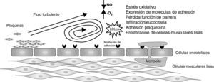 Inicio del proceso aterosclerótico generado por un flujo turbulento. El flujo turbulento reduce la generación a nivel local de óxido nítrico (NO) y acelera la formación de anión superóxido (O2-). Este puede promover un estado protrombótico, oxidativo y proliferativo en la superficie vascular, promoviendo la infiltración de leucocitos hacia el espacio subendotelial5.