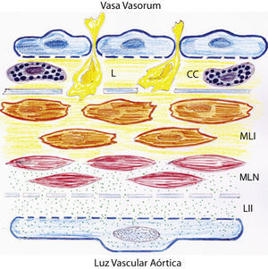 Dibujo representativo de las alteraciones inflamatorias de la pared de la aorta abdominal en ratas con hipertensión portal prehepática crónica. Estas alteraciones se pueden producir por dos mecanismos fundamentales que implican respectivamente el endotelio aórtico, con lesión de la íntima, y los vasa vasorum, con afectación de las capas adventicia y media. CC: células cebadas; L: leucocitos; LII: lesión inflamatoria de la íntima; MLI: células musculares lisas lesionadas por un mecanismo inflamatorio; MLN: células musculares lisas normales.