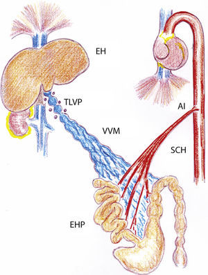 Dibujo representativo de las alteraciones inflamatorias esplácnicas y sistémicas en ratas con hipertensión portal prehepática crónica. AI: aortopatía inflamatoria; EH: esteatosis hepática; EHP: enteropatía hipertensiva portal; SCH: síndrome circulatorio hiperdinámico esplácnico y sistémico; TLVP: triple ligadura parcial de la vena porta; VVM: vasculopatía venosa mesentérica.