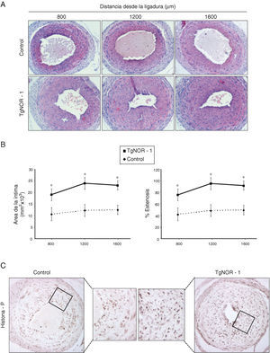 En los animales transgénicos de NOR-1 se exacerba el remodelado vascular inducido mediante ligadura de la arteria carótida. Se realizó una ligadura permanente de la arteria carótida izquierda tanto en animales control como en ratones transgénicos (TgNOR-1). A)Se muestra la tinción con hematoxilina/eosina de secciones de las carótidas ligadas situadas a 800, 1.200 y 1.600μm del punto de ligadura. B)Cuantificación del área de la capa íntima y del porcentaje de estenosis en estas regiones. Los datos se expresan como media±SEM (n=6). *p<0,01 vs. control. C)Tinción inmunohistoquímica para la histona H3 fosforilada (histona-P) en secciones de arterias carótidas ligadas procedentes de ratones transgénicos y controles.