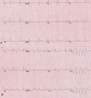 A) Electrocardiograma basal con bloqueo incompleto de la rama derecha. B) Electrocardiograma tras estudio con dobutamina, con evidencia de elevación del ST generalizado y racha de taquicardia ventricular no sostenida (en derivaciones de V4 a V6).