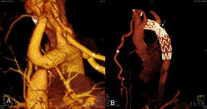 A)Angio TC de aorta mostrando, inmediatamente distal al nacimiento de la subclavia izquierda, estenosis del 95% a nivel de la aorta descendente (flecha). Dilatación de ambas arterias mamarias (asterisco). B)Prótesis a nivel de aorta torácica descendente sin datos de complicación a su nivel. La flecha señala donde se encontraba previamente la zona coartada. Dilatación de la arteria mamaria derecha (asterisco).