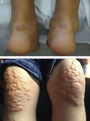 Xantomas cutáneos y tendinosos en HFHo. Los xantomas en niños son altamente sugestivos de un diagnóstico de HFHo.Las fotografías han sido amablemente cedidas por el Dr. Luis Masana (A) y el Dr. Pedro Mata (B).