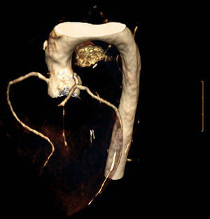 Reconstrucción mediante angio-TAC del árbol coronario de un niño de 9años afecto de HFHo. Se observan arterias coronarias sin lesiones críticas pero de contornos difusamente arrosariados.Imagen amablemente cedida por el Dr. Luis Masana.