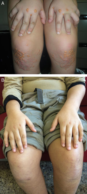Caso clínico en el que se aprecian xantomas en rodillas y manos a la edad de 6años (A) y a la edad de 11años tras 4años de tratamiento con aféresis de LDL (B).Las fotografías han sido amablemente cedidas por el Dr. Pedro Mata (A) y la Dra. Cristina Arbona (B).