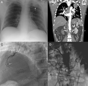 A) Radiografía de tórax en posteroanterior evidenciando una masa a nivel del lóbulo superior izquierdo (flecha). B) Tomografía computarizada toracoabdominal, corte coronal, donde se evidencian la masa pulmonar (flecha) y la oclusión de la aorta a nivel abdominal (asterisco). C) Coronariografía (oblicua anterior derecha) en la que se evidencia oclusión de la coronaria derecha a nivel de tercio medio (flecha). D) Aortografía abdominal (anteroposterior) donde se evidencia oclusión a nivel de la aorta abdominal (flecha) con abundante circulación colateral.