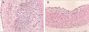 Cortes histológicos de las aortas de los conejos al final del estudio. Lesión tipo IV (panel A). Se observan en la íntima arterial cúmulos de lípidos intracelulares y extracelulares en mayor extensión de un conejo perteneciente al grupo 2. Lesión tipo II (panel B). Se observan en la íntima arterial cúmulos de lípidos intracelulares de un conejo perteneciente al grupo 4. Tinción hematoxilina-eosina, ×50.