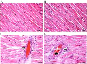 Histopathology of H&E stained ventricular cardiac tissues (200x magnification). A: Wistar rat fed standard diet, B: SD rat fed standard diet, C: Wistar rat fed high fat diet and D: SD rat fed high fat diet. Asterisks represent dilated congestion of blood vessel. White arrows represent the accumulation of mononuclear cells associated with inflammation. Black arrow represents perivascular fat surrounding the blood vessel.