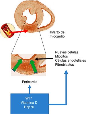 Infarto agudo de miocardio. En la parte superior de la figura se esquematiza una oclusión de la arteria coronaria, lo que provoca el desarrollo de un área con infarto agudo de miocardio. En el centro de la figura se destaca —como imagen ampliada— que este evento determina un área necrótica, lo que promueve la activación de células con capacidad de regeneración. La parte inferior de la figura representa a células que invaden la pared ventricular infartada desde el pericardio y que dichas células conjuntamente con las que poseen la capacidad de regeneración serían moduladas positivamente por WT1, los niveles de vitamina D y Hsp70.
