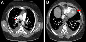 (A) Presence of PE in the right upper lobe (red asterisk). (B) Presence of LV thrombus (red arrow).