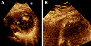 (A) Transversal view of LV thrombi (yellow star). (B) oblique view of LV thrombus (white dash line).