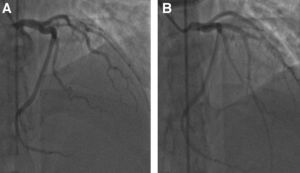 Pre (A) and post stent (B) placement on LAD during left heart catheterization.