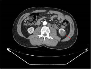 AngioTC donde se observa imagen con defecto de perfusión renal en cuña, sugerente de infarto renal izquierdo de polo inferior.
