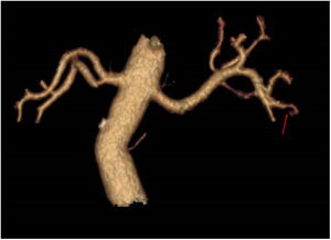 Reconstrucción tridimensional de aorta abdominal, arterias renales y ramas segmentarias. La flecha señala una de las ramas segmentarias para el polo inferior con marcada disminución del calibre vascular.