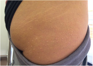 Xantomas eruptivos en una paciente con síndrome de quilomicronemia.