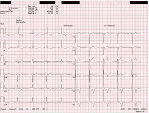 Electrocardiograma a la llegada a Urgencias. Se pueden observar criterios positivos para Sokolow-Lyon y ondas T negativas y profundas sugestivas de hipertrofia ventricular.