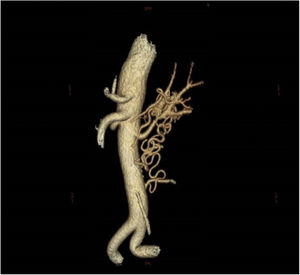 La angio-TC mostró una estenosis crítica en el tercio medio de la arteria renal izquierda, con una malformación vascular agrandada, torcida y enmarañada en el hilio renal que se extendía caudalmente con numerosas colaterales que unían las arterias vertebral y mesentérica.