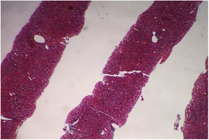 Biopsia hepática percutánea sin evidencia de cirrosis. Fuente: Unidad de Anatomía Patológica. Historia Clínica AS400. HECAM.
