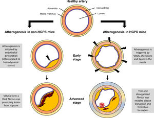 Comparison of atherogenesis in Hutchinson-Gilford progeria syndrome (HGPS) and non-HGPS mouse models. In non-HGPS animals (Apoe−/− and Ldlr−/−), atherosclerosis typically begins with endothelial dysfunction, often associated with hemodynamic stress. Activated endothelial cells (ECs) recruit immune cells to the artery wall, leading to atheroma lesion growth. Vascular smooth muscle cells (VSMCs) start to migrate from the media toward the intima, where they proliferate and synthesize extracellular matrix to form a fibrous cap preventing plaque disruption. In HGPS animals (Apoe−/−LmnaG609G/G609G and Ldlr−/−LmnaG609G/G609G), atherogenesis is triggered by alterations in VSMCs and their death in the medial layer. The consequent VSMC depletion in the fibrous cap leads to highly unstable atheroma lesions that can easily break, resulting in life-threatening thrombus formation.