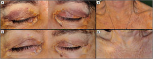 Baseline bilateral xanthelasma (Panel A) and extensive cutaneous xanthomas localized at the trunk (Panel B). Partial regression in xanthelasma (Panel C) and in cutaneous xanthomas hyperpigmentation (Panel D) obtained after six months of maximal lipid lowering therapy (rosuvastatin/ezetimibe 20/10mg OD+evolocumab 140mg s.c. every 14 days+lipoprotein apheresis).