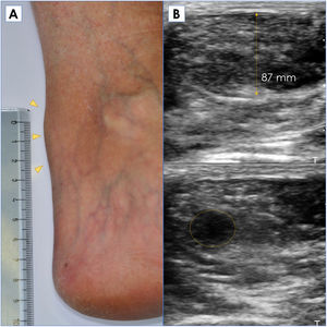 Panel A – Physical examination of Achilles tendon xanthomas (arrowhead). Panel B – Achilles tendon ultrasonography with increased thickness and irregular hypoechoic region (circle).